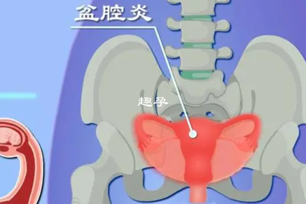 输卵管积水能否做试管婴儿解析