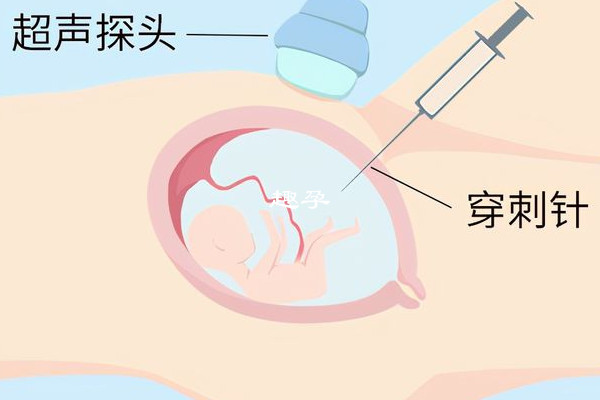 二代試管懷雙胎不一定需要做羊穿