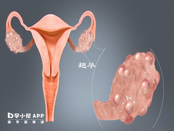 卵巢早衰卵泡少試管成功的機率不大