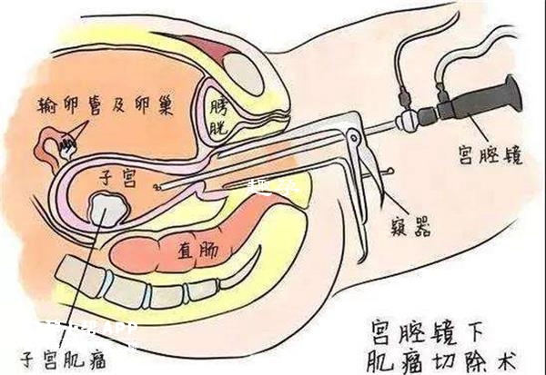 宮腔灌注示意圖