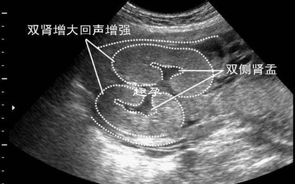 腎盂分離不是百分百生男孩