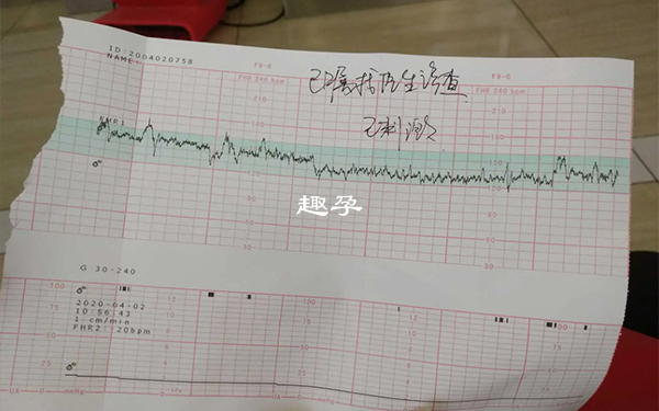 胎心监护一般是20分钟完成