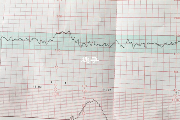 胎監宮縮壓強度60是5級痛