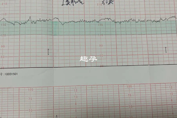 孕妇晚上失眠是会影响第二天的胎心监护结果