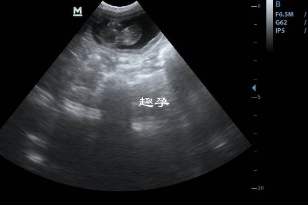 四维大排畸可以检测兔唇